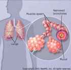профилактика астмы